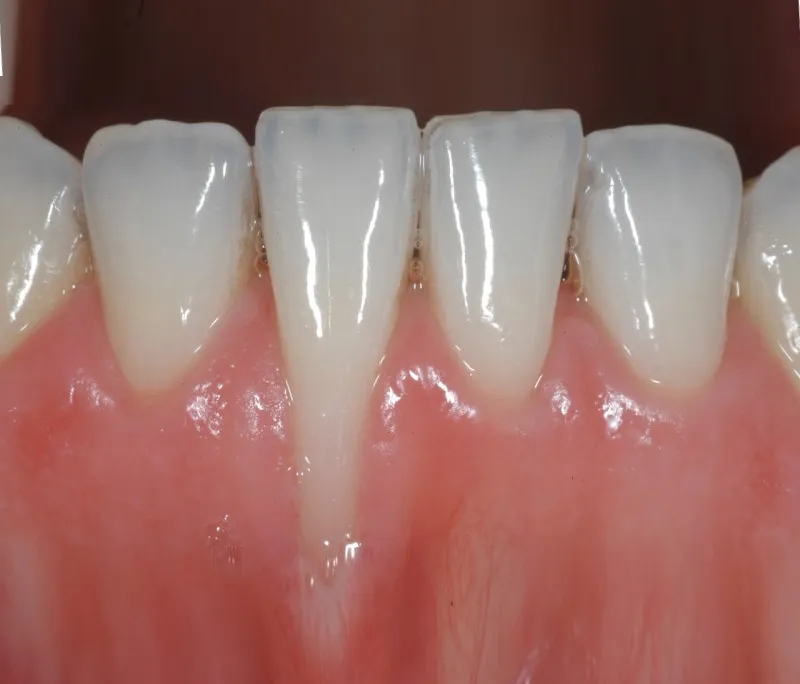 Bị tụt lợi có bọc răng sứ được không?