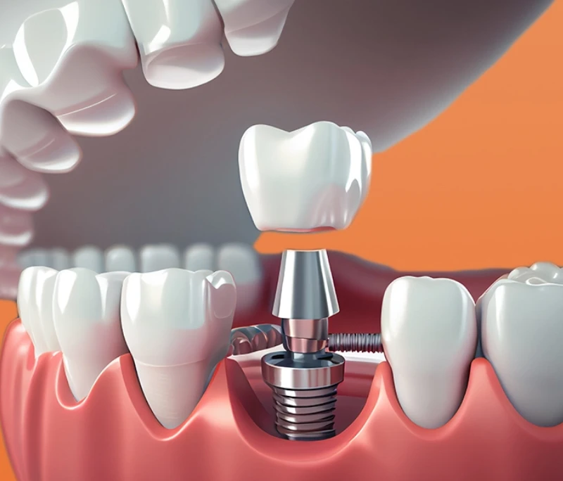 Cấy Implant có đau không? Cách chăm sóc sau khi trồng răng Implant