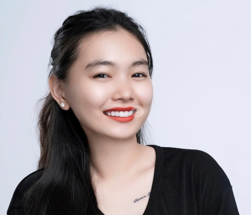 Răng sứ DDBio giá bao nhiêu? Có tốt không?