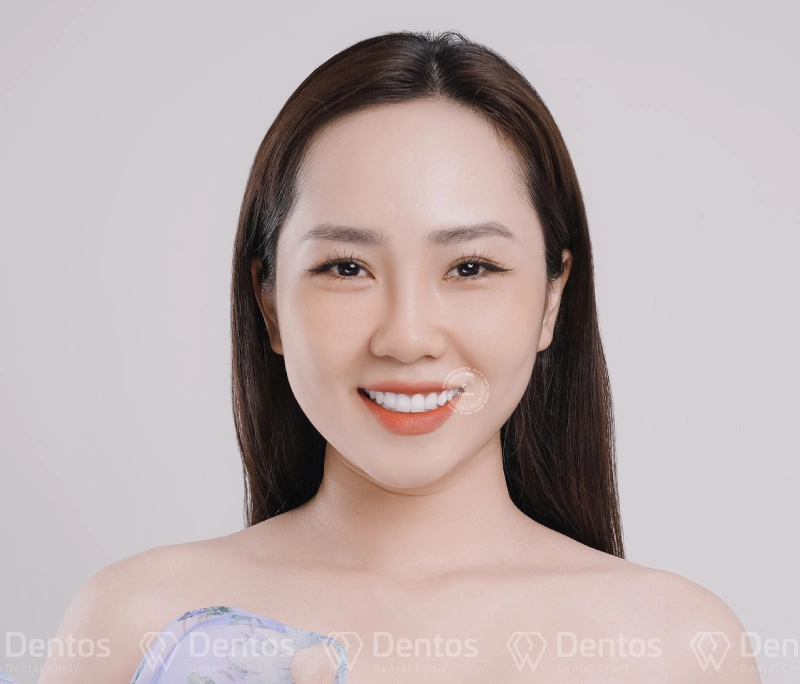 Răng sứ Lava Esthetic: Đỉnh cao thẩm mỹ với công nghệ độc đáo từ 3M