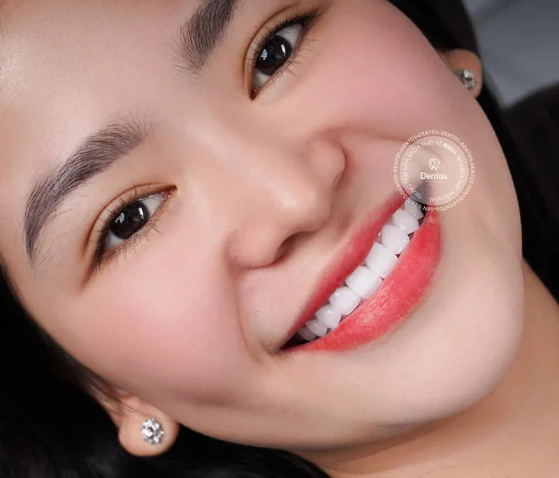 Các loại răng sứ phổ biến 2025: Ưu nhược điểm & Loại nào tốt nhất?