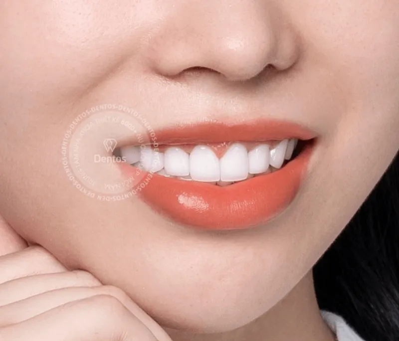 Bí quyết vàng để chăm sóc răng sứ luôn bền đẹp như mới theo thời gian