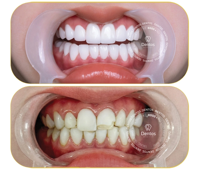 Bọc răng sứ răng cửa: Nên chọn loại nào & Chi phí bao nhiêu?