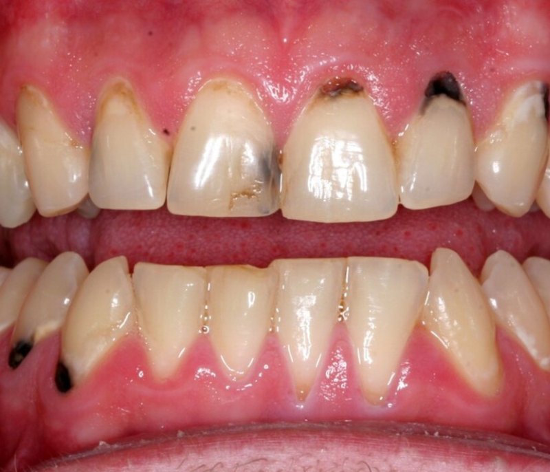 Bọc răng sứ giá rẻ: 5 hiểm họa tiềm ẩn bạn nhất định phải biết