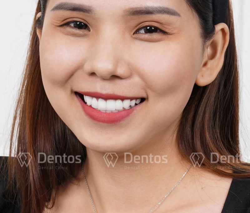 Răng trắng sáng giúp vẻ ngoài “lột xác” với nụ cười sang trọng tinh tế