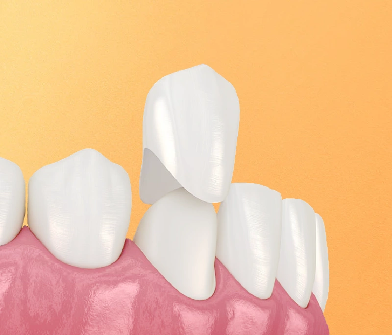 Bọc răng sứ mất bao lâu? Địa chỉ nha khoa uy tín tại TP.HCM?