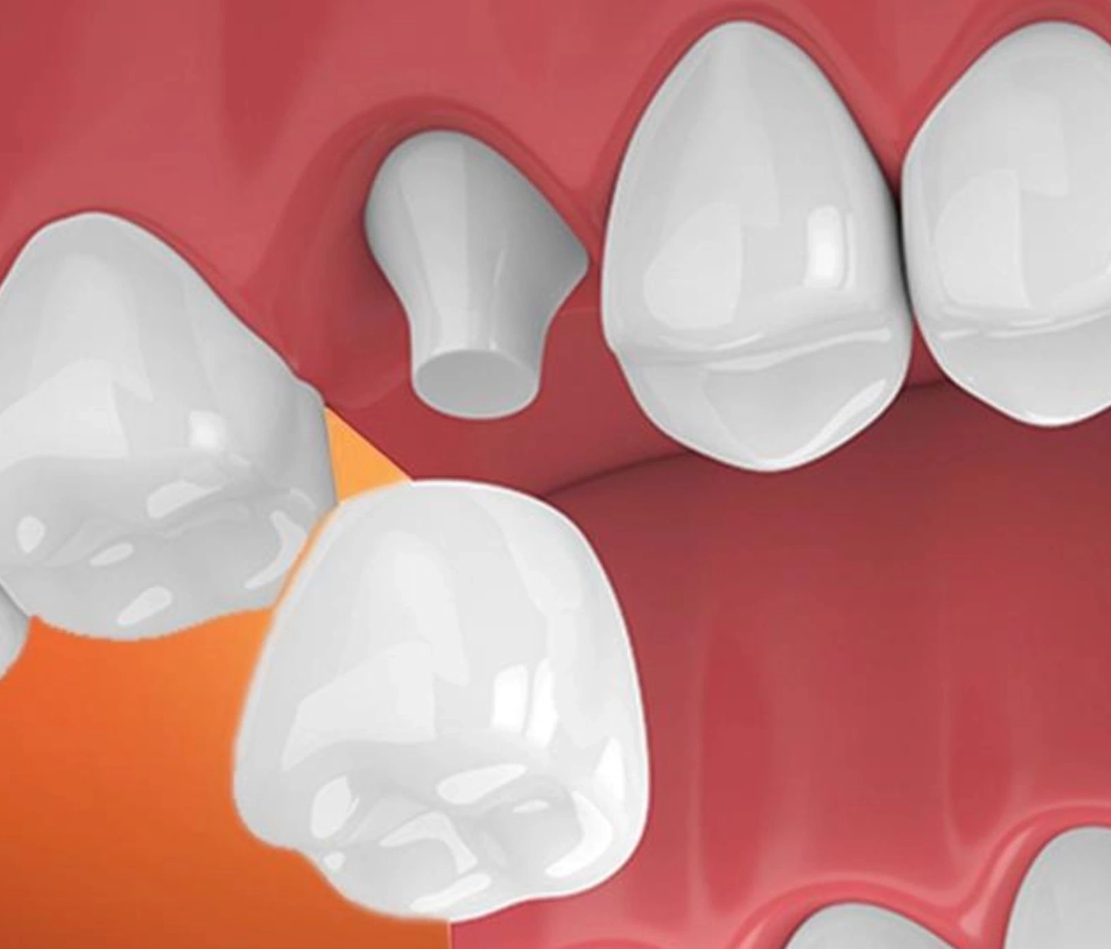 Bọc răng sứ 1 chiếc được không? Cần lưu ý điều gì?