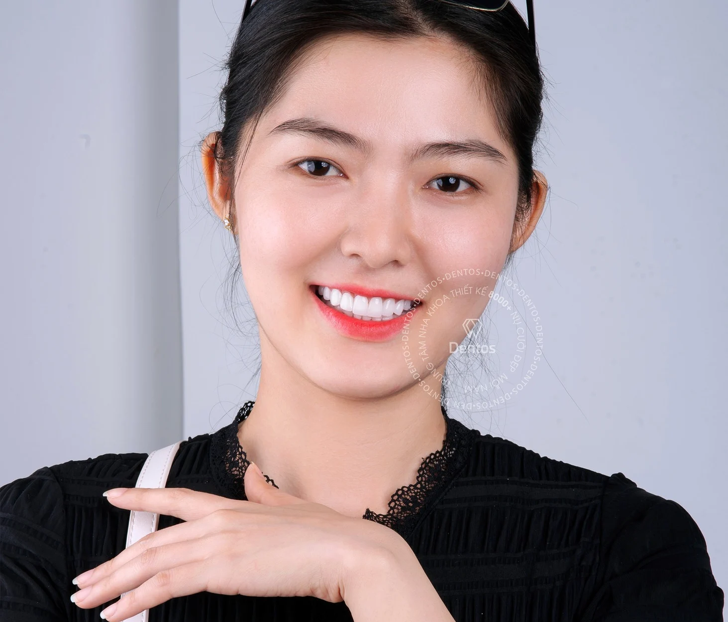 Răng vỡ lớn có bọc răng sứ được không?