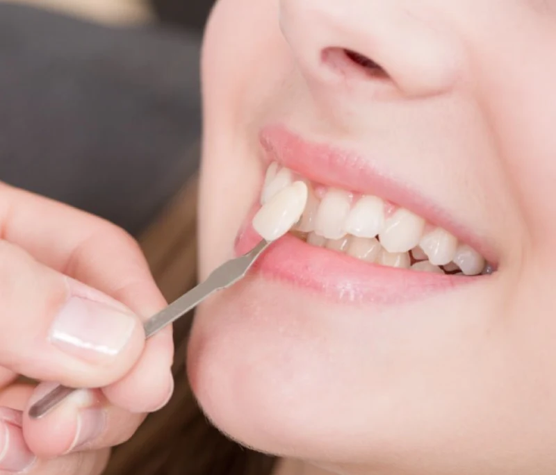 Dán Veneer siêu mỏng Dentos: Xâm lấn tối thiểu - Thẩm mỹ tối đa