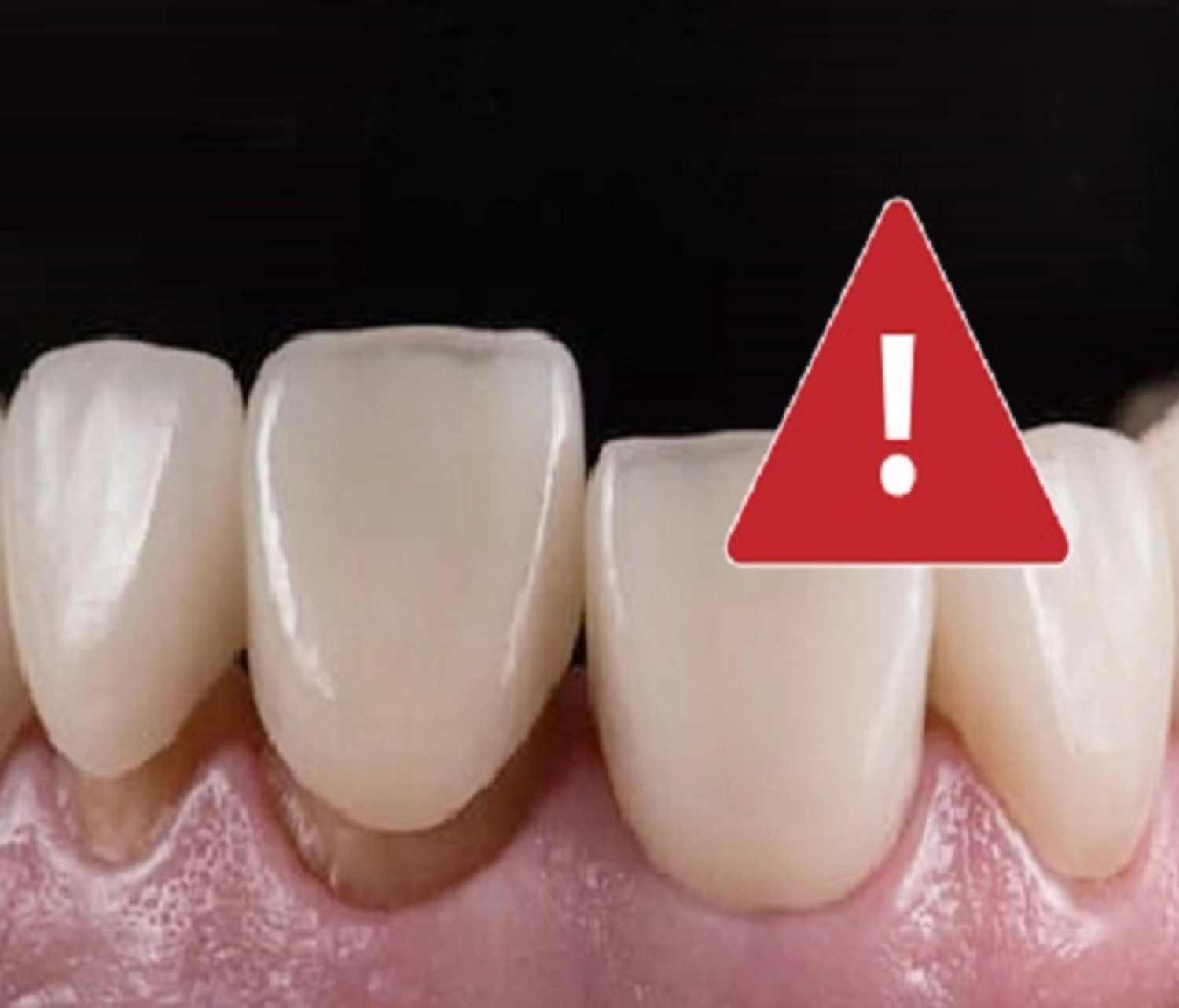 Răng sứ bị rớt ra là do đâu? Xử lý thế nào?