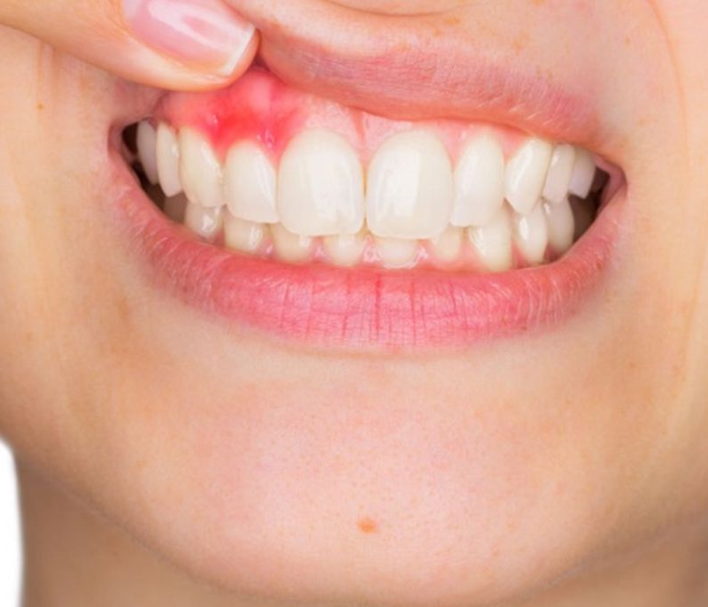 Bị viêm lợi sau khi bọc răng sứ: Nguyên nhân và cách điều trị dứt điểm