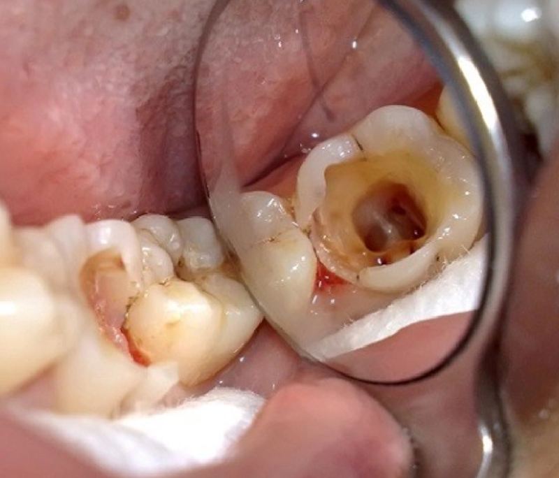 Khi nào cần lấy tủy răng? Quy trình điều trị tủy chi tiết & an toàn