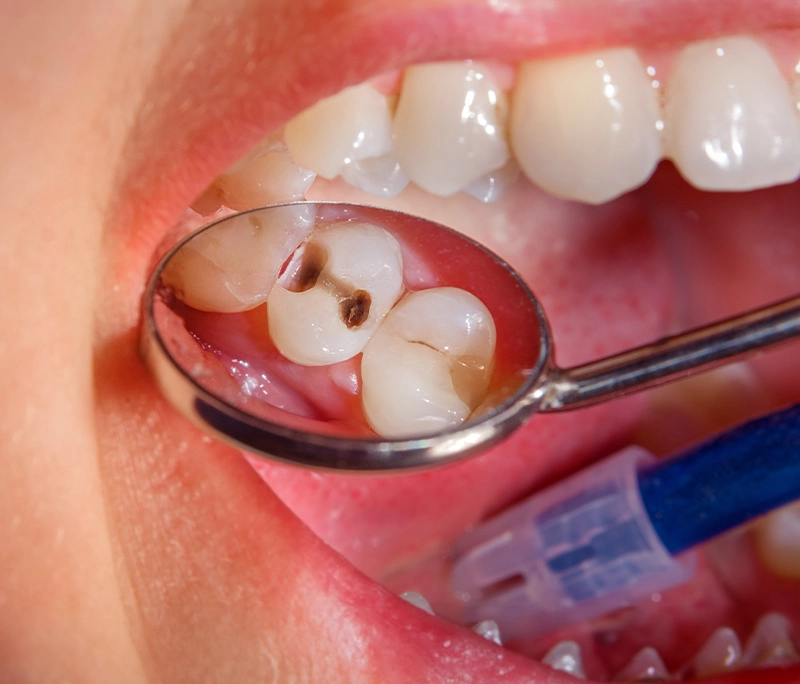 Răng chữa tủy có nhất thiết phải bọc răng sứ?