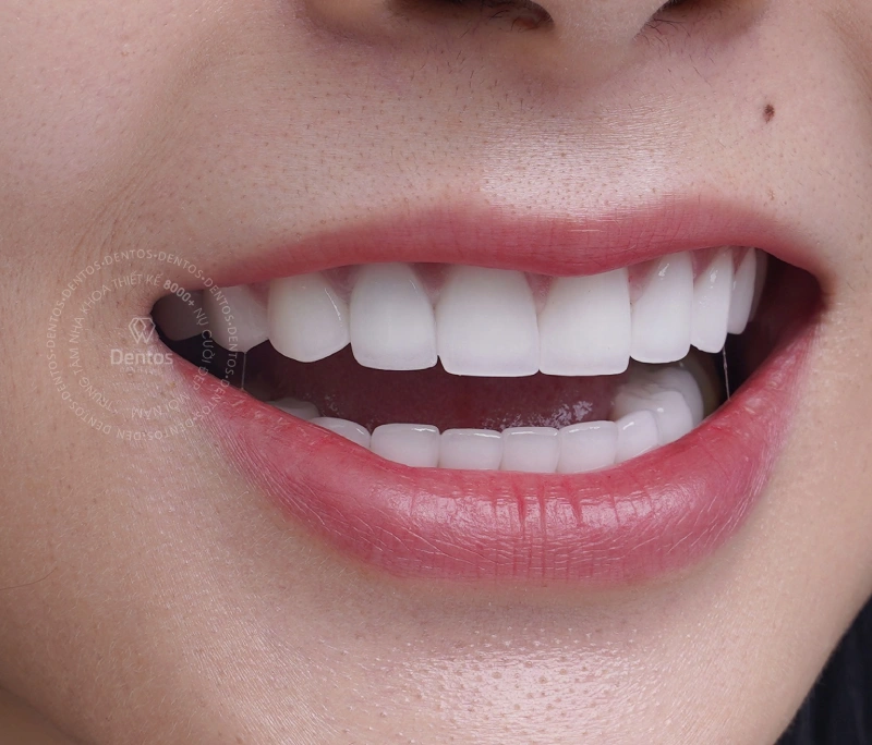 Giải mã bọc răng sứ có bị hư răng thật không?