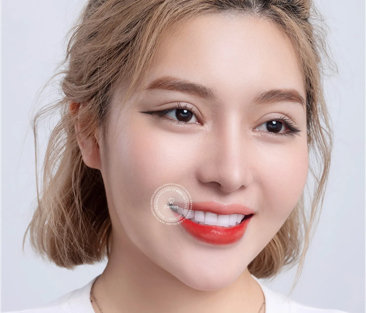 Trụ Tekka Implant Pháp - Cấu tạo, ưu nhược điểm và giá cả