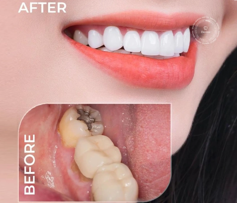 Vì sao điều trị tủy răng cần kết hợp bọc răng sứ?