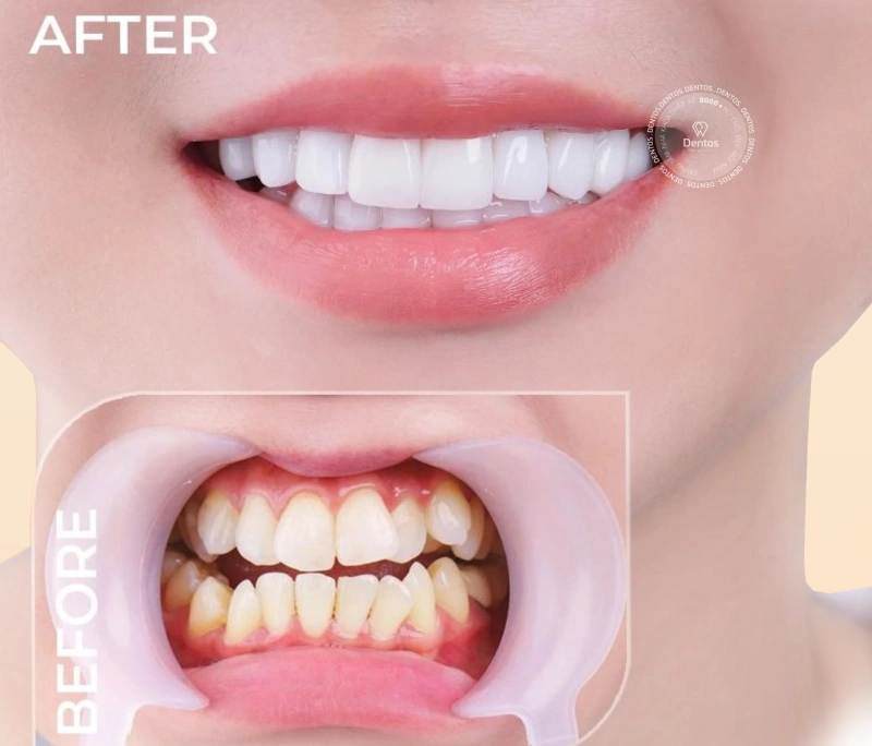 Bọc sứ răng khểnh: Nên hay không?