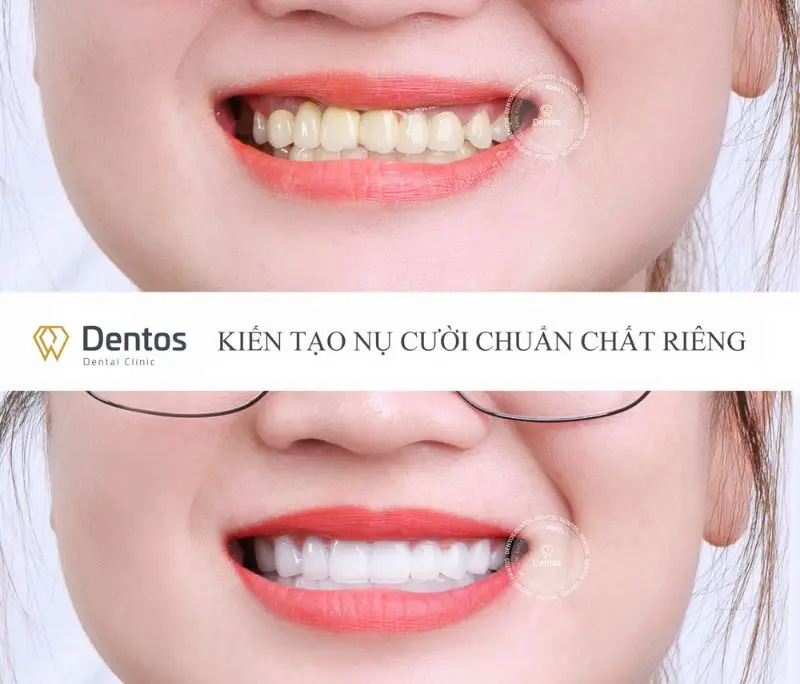 Dán răng sứ hay bọc răng sứ thì tốt hơn?