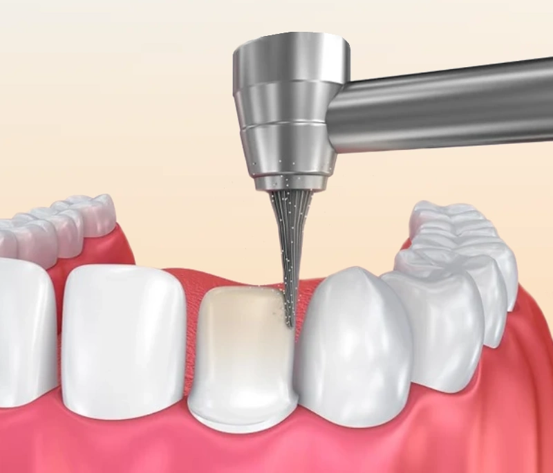 Mài răng sứ có đau không? Có hại răng thật không?