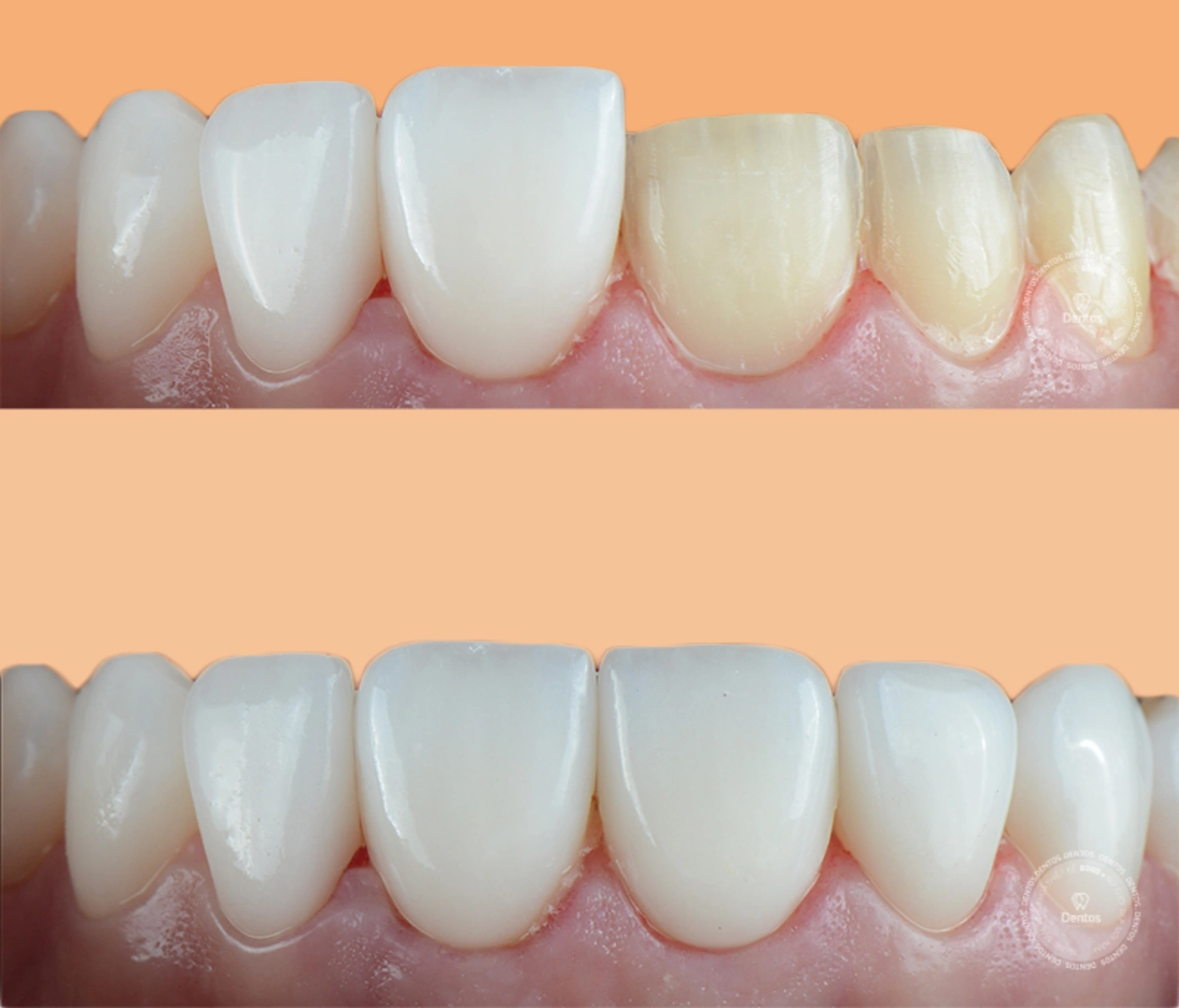 Veneer Emax là gì? Nên dùng cho trường hợp nào? Giá bao nhiêu?