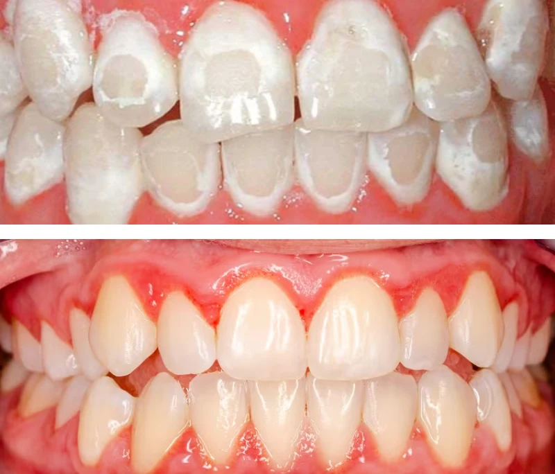 Cảnh báo: 5 rủi ro tiền mất tật mang khi dán Veneer sai cách