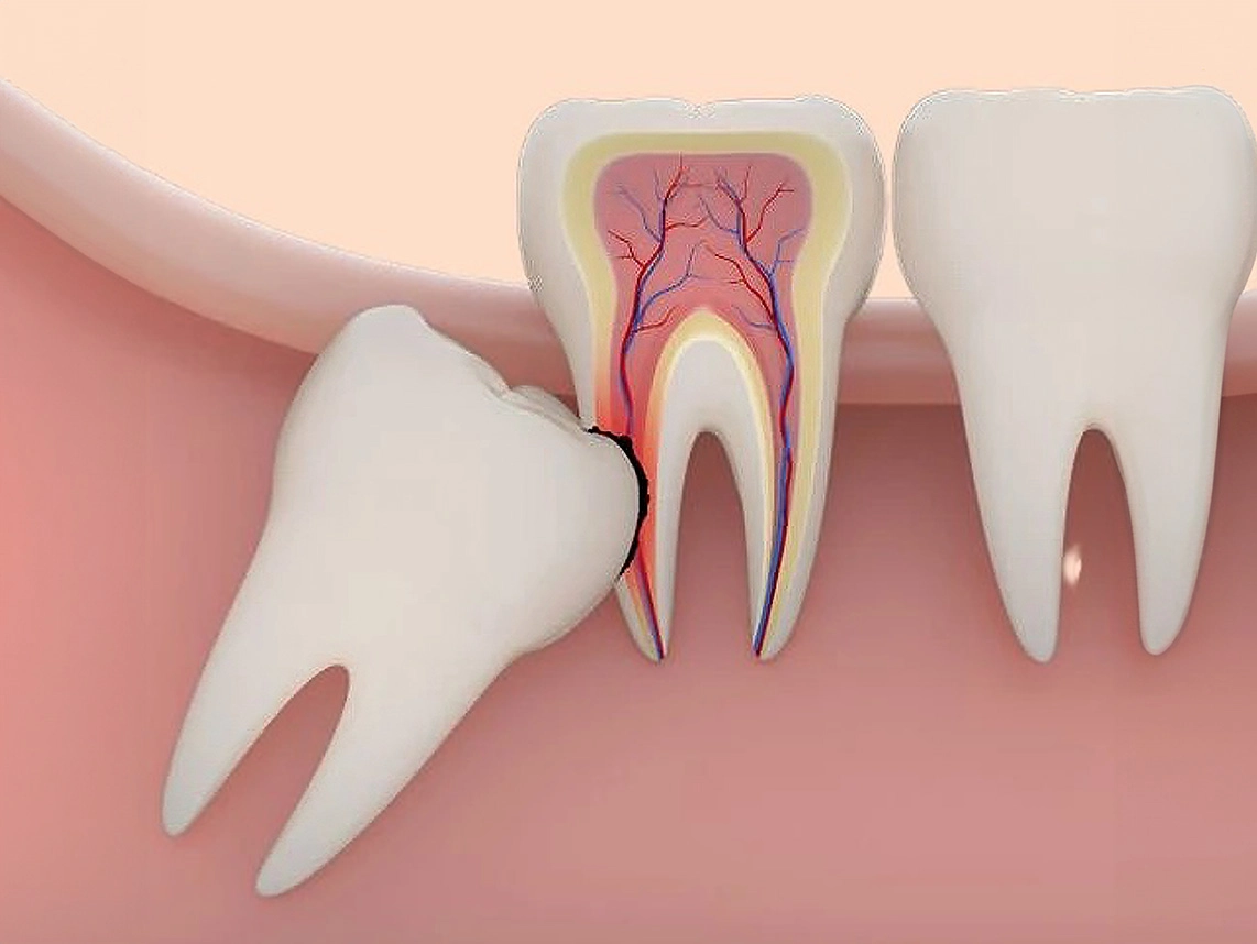 Nhổ Răng: Không Chỉ Là Lấy Đi Răng Hỏng! 1
