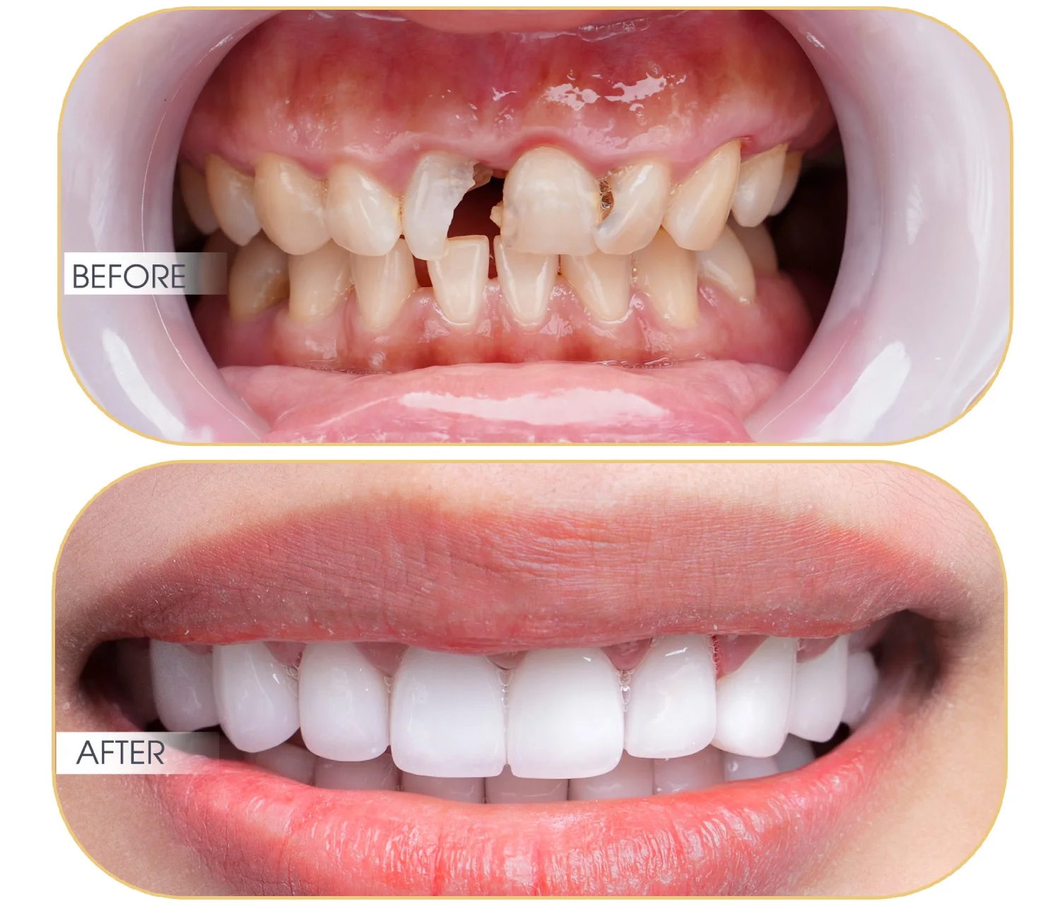 Bọc răng sứ hàm trên: Khi nào nên bọc? Bọc loại nào?