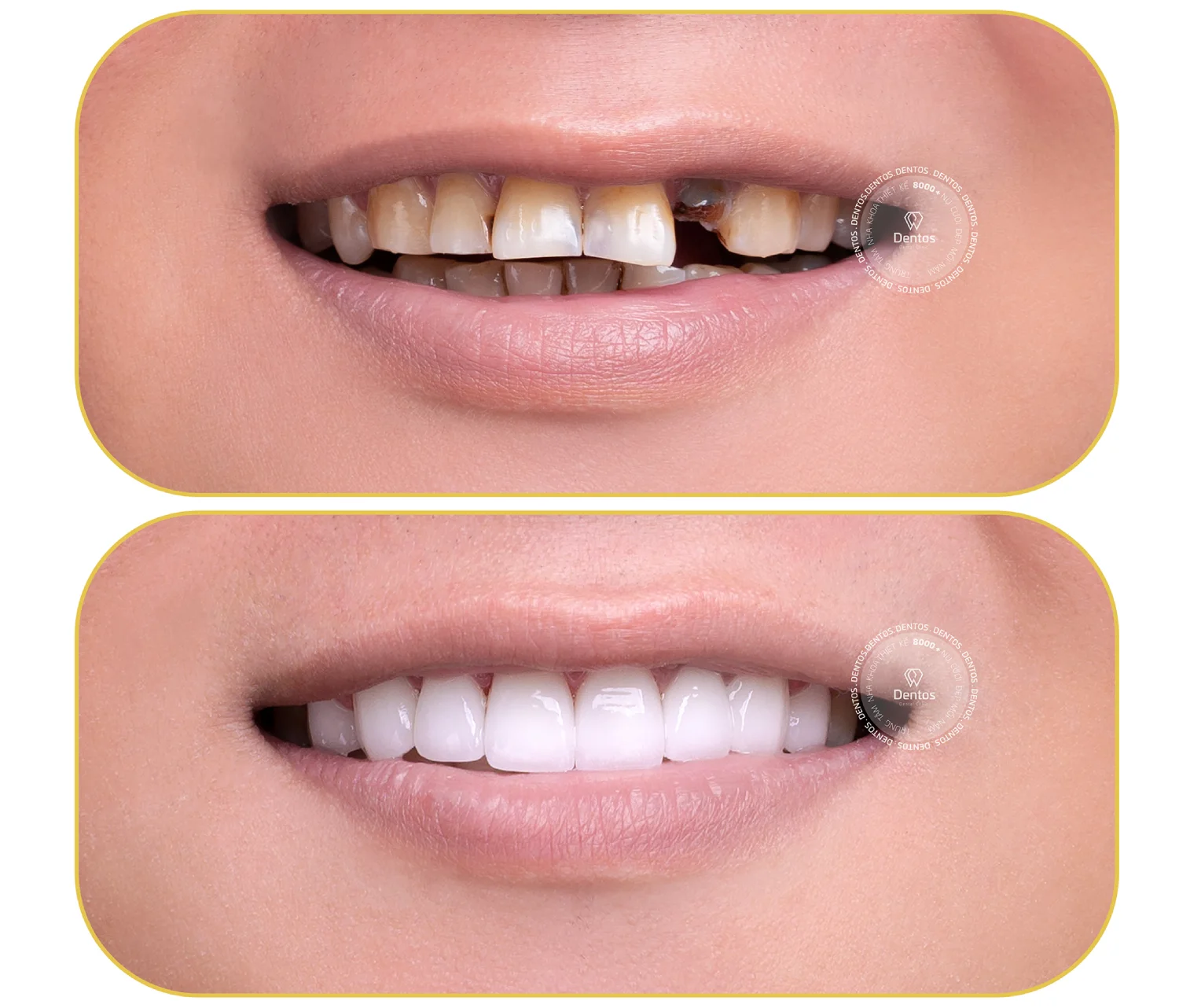 Những trường hợp nên bọc răng sứ bạn cần biết