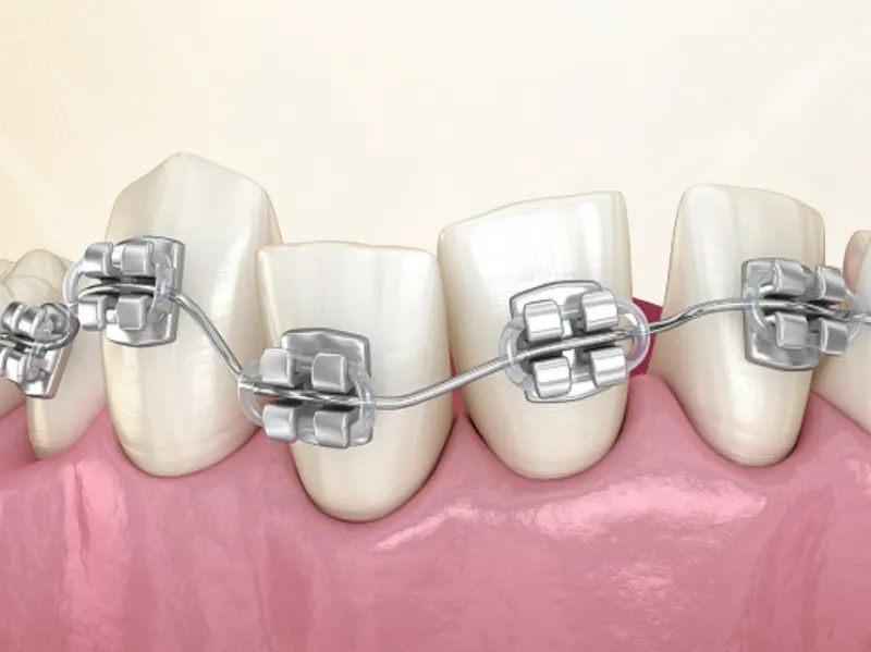 Niềng Răng Mắc Cài Hoạt Động Như Thế Nào?