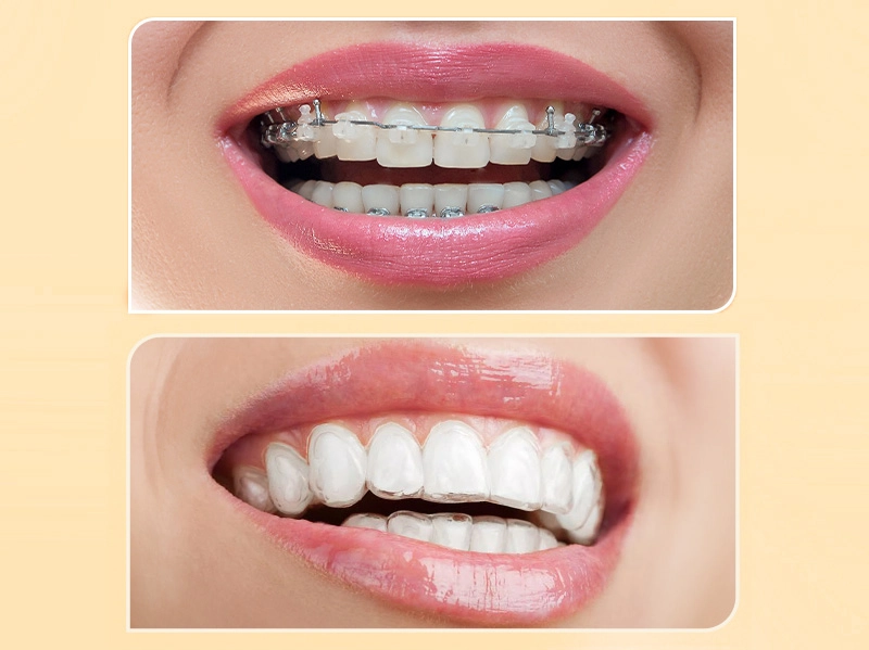 Mắc Cài Sứ vs. Khay Trong Suốt