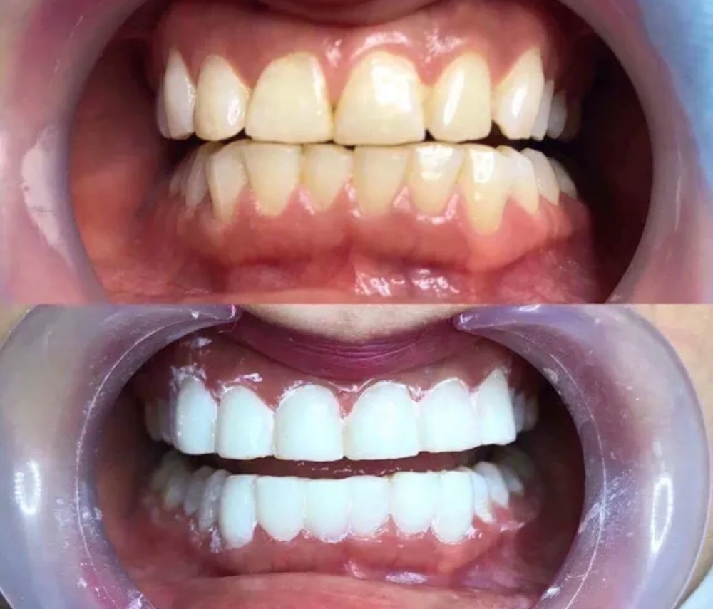 Phủ sứ nano là gì? Phủ sứ nano có phải bọc răng sứ không?