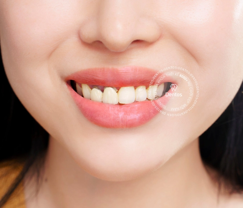 Tại sao răng sứ bị hở và răng sứ bị ngấm nước bọt? 