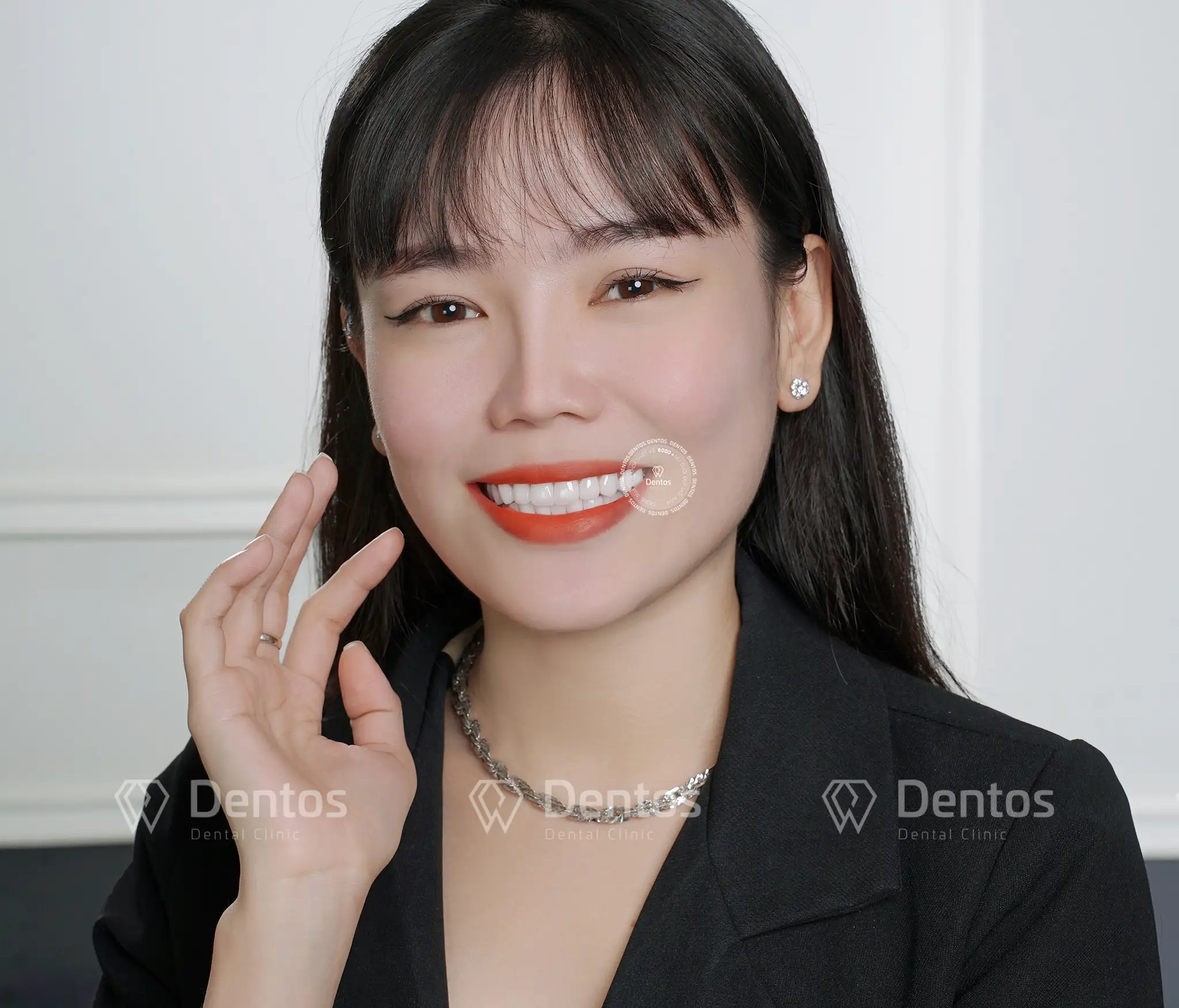 Răng sứ bị mẻ thì có trám được không?