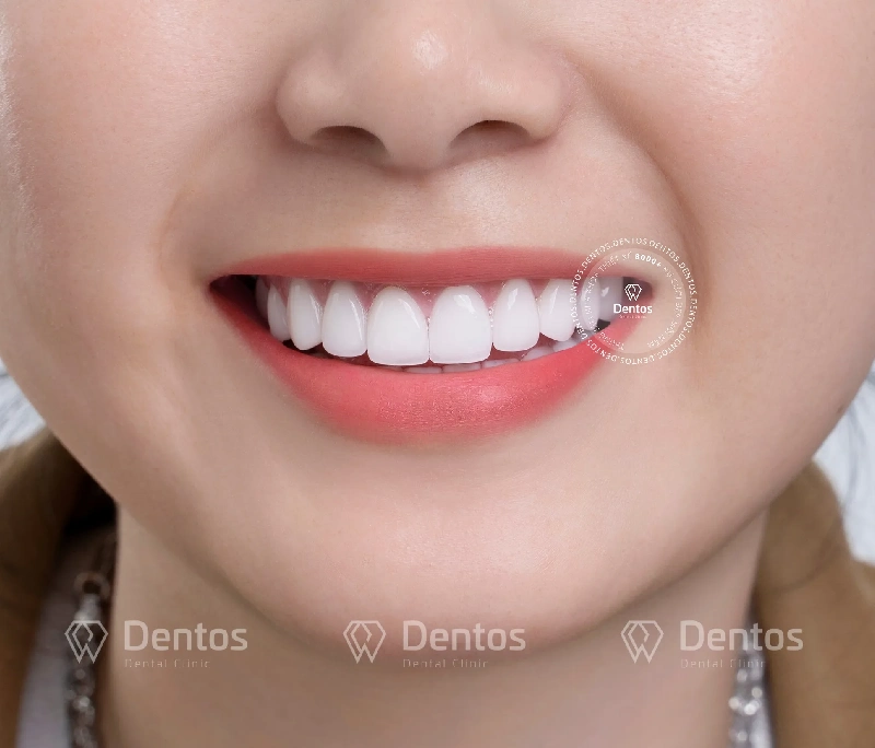 Bọc răng sứ bao lâu thì ăn uống bình thường?