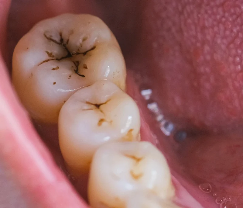 Bọc răng sứ cho răng sâu: Khi nào cần & chi phí bao nhiêu?