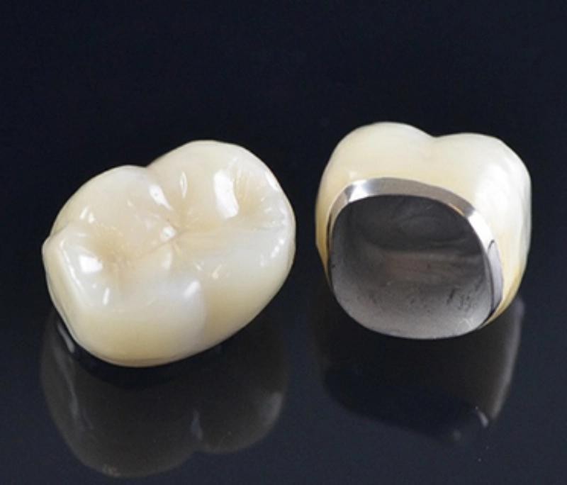 Những tác hại khi bọc răng sứ kim loại bạn nên biết