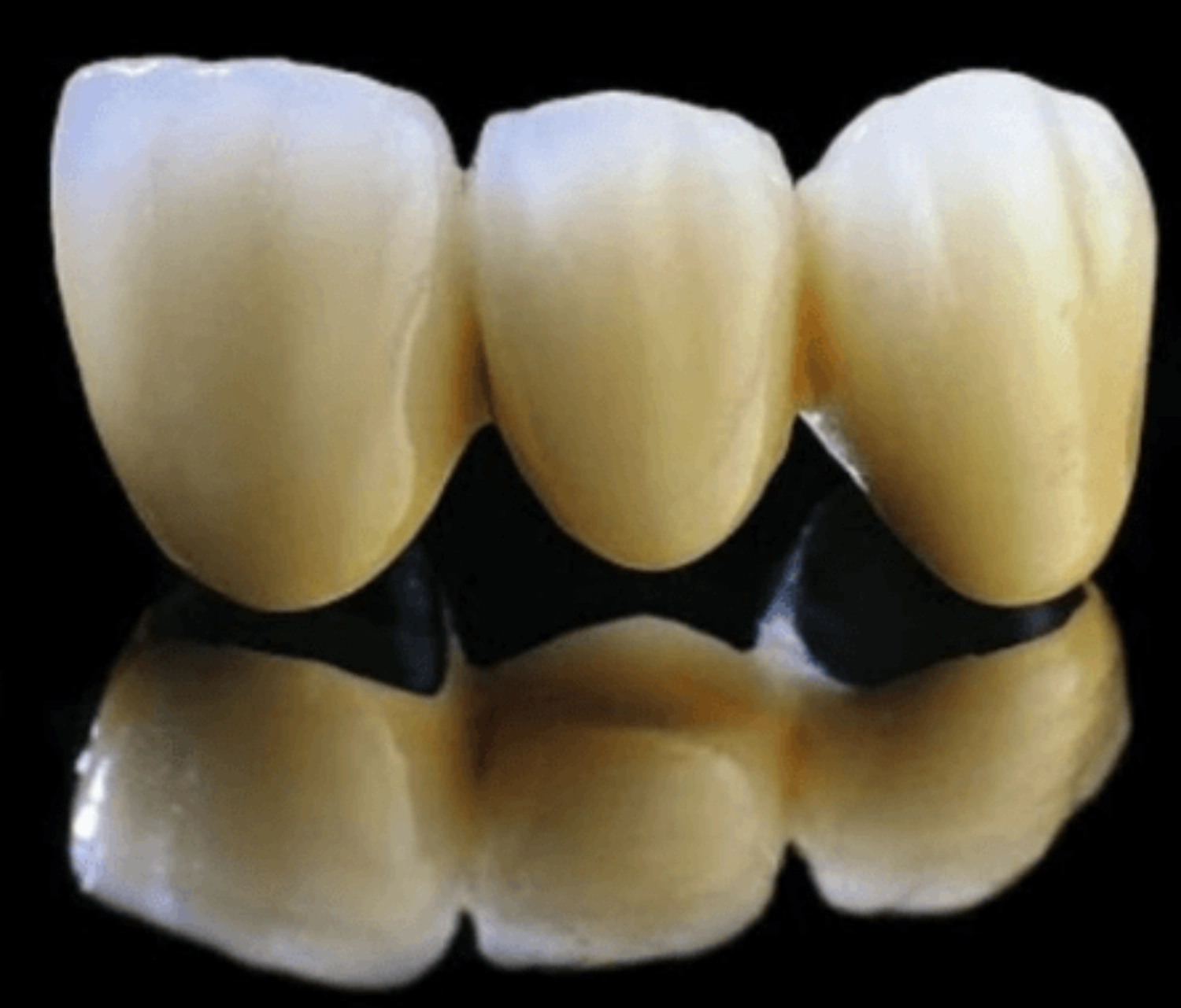 Răng sứ kim loại - 4 tác hại không phải ai cũng biết