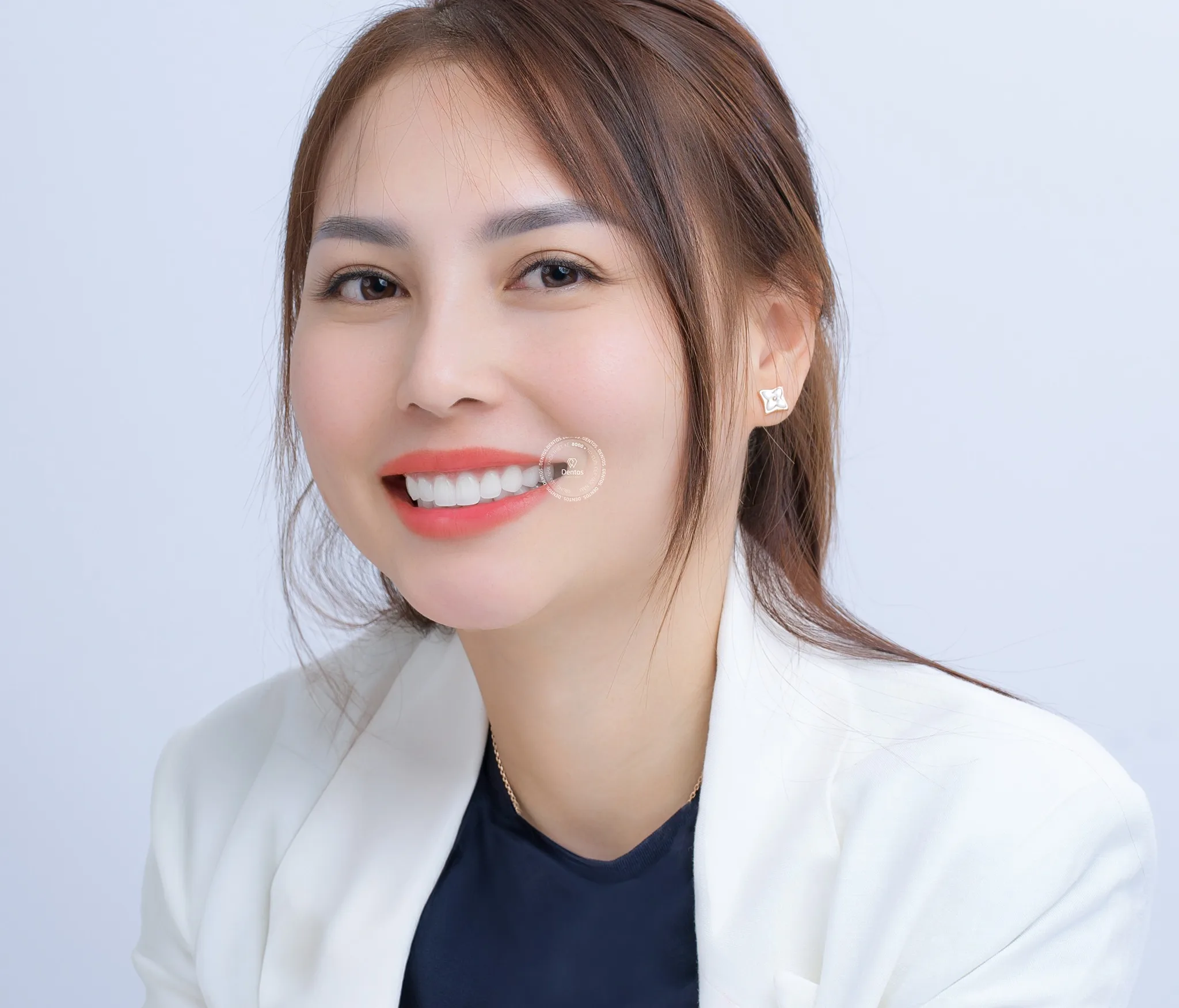 Làm răng sứ thẩm mỹ: Tốt hay xấu? Những rủi ro bạn phải biết