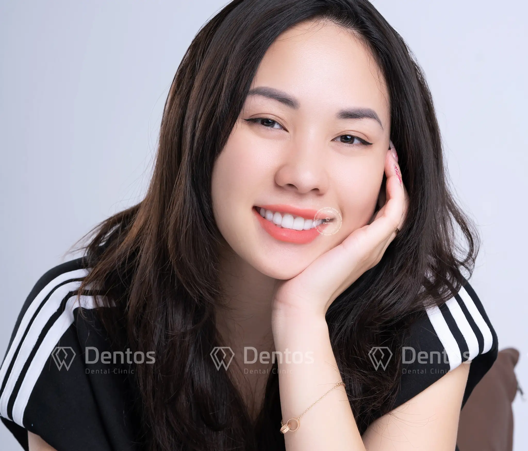 So sánh răng sứ Cercon Ht và Ht Smile: Lựa chọn nào tốt hơn?