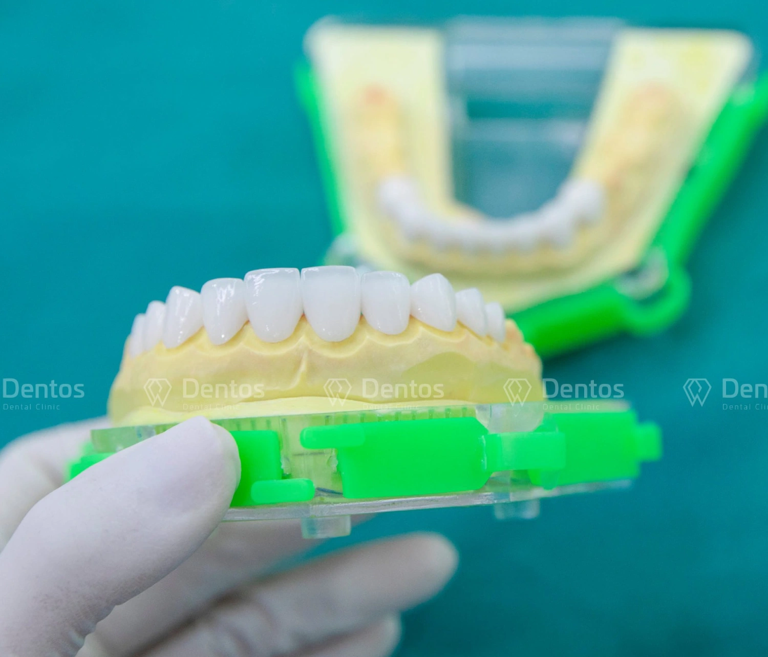 Ưu nhược điểm các loại răng sứ trên thị trường - Đâu là lựa chọn tốt?