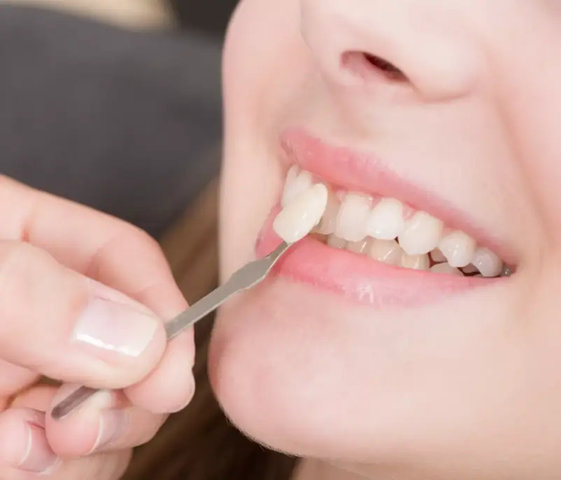 Răng khấp khểnh dán răng sứ được không?