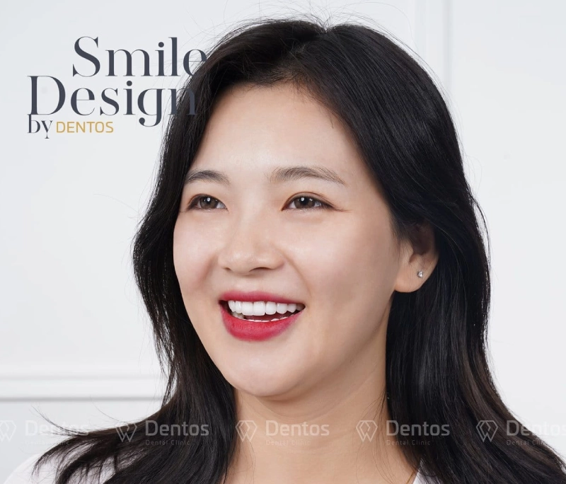 Khách hàng răng nhạy cảm – sợ đau trải nghiệm làm răng tại Dentos