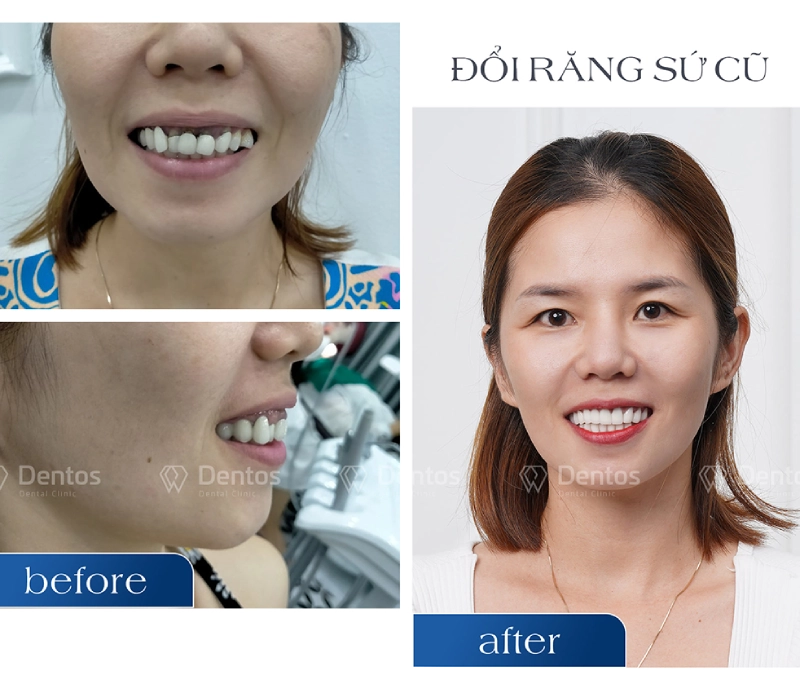 Đổi răng sứ cũ lấy răng sứ mới có hiệu quả không?