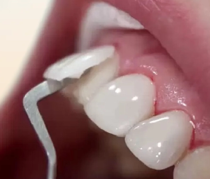 Tháo răng sứ có đau không? 6 Dấu hiệu bạn cần làm lại răng sứ ngay