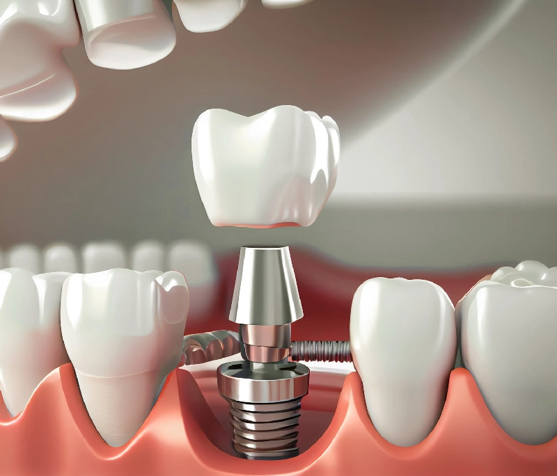 Implant của Pháp loại nào tốt? Các tiêu chí lựa chọn