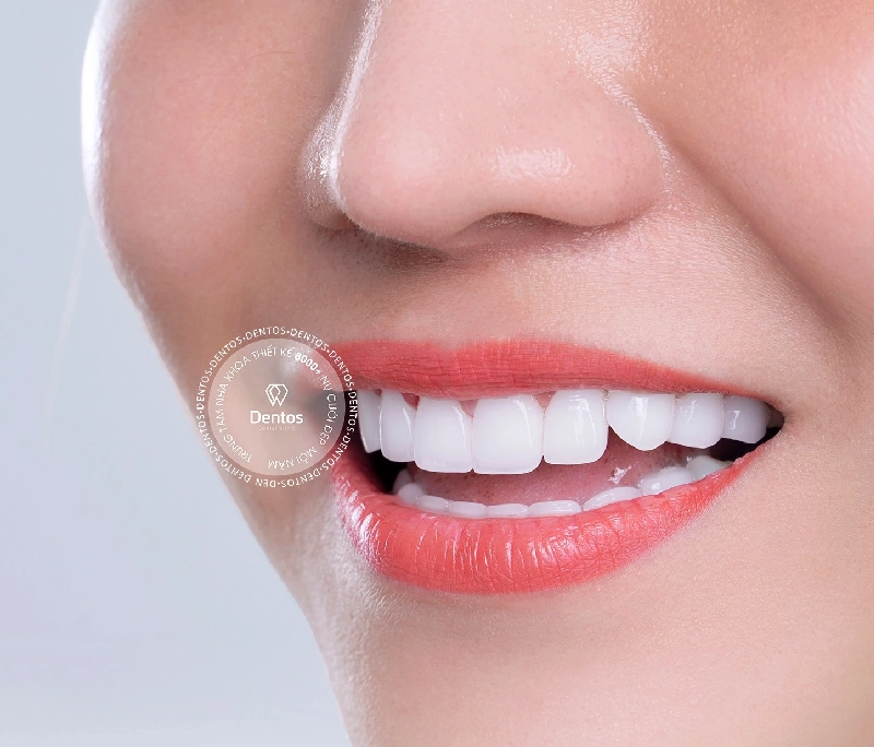 Bọc sứ có giữ được dáng răng khểnh không?