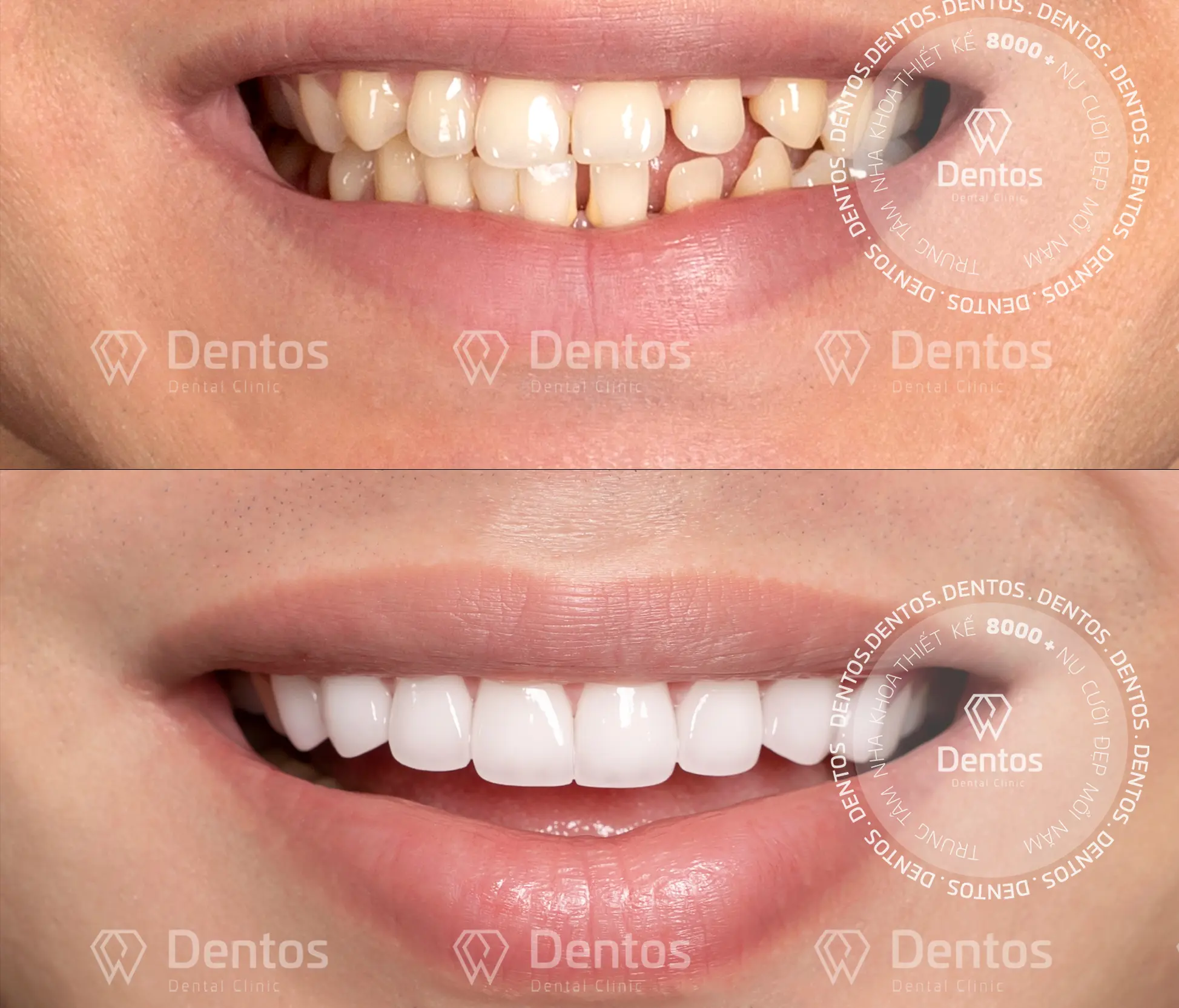 Những thắc mắc thường gặp trước và sau khi bọc răng sứ