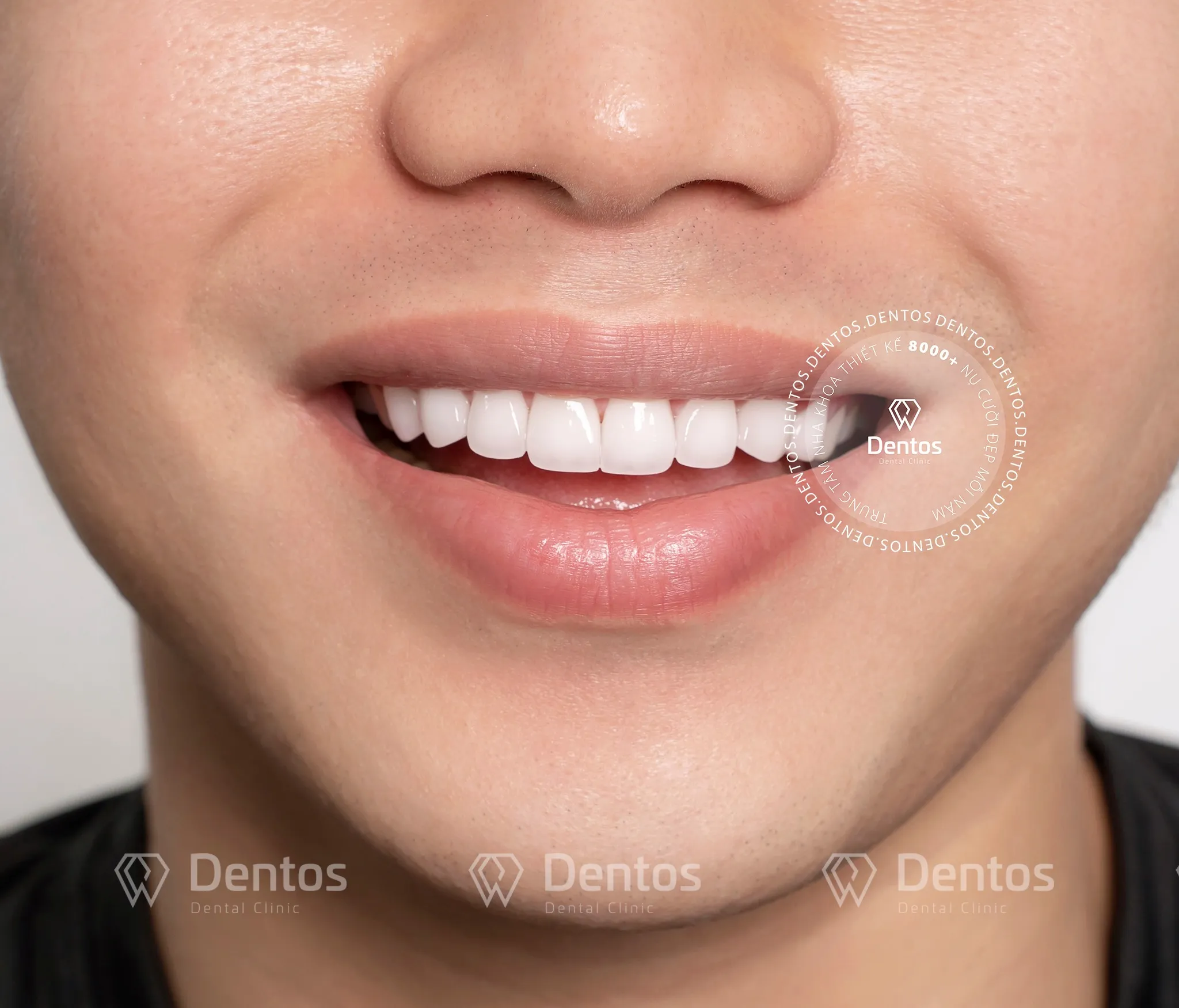 Bọc răng sứ có bị mòn không? Nếu bị phải làm sao?