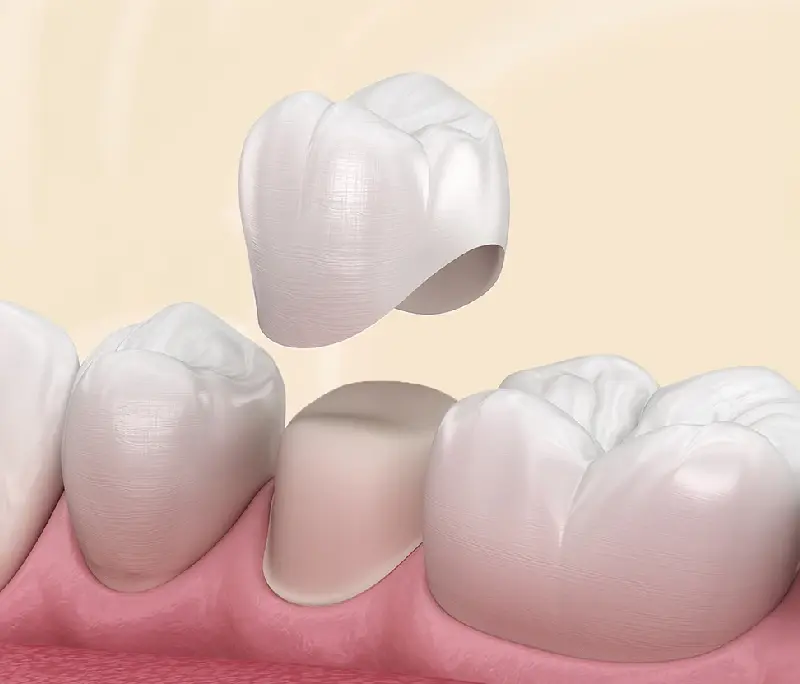 Răng tạm là gì? Lắp răng tạm có ăn uống bình thường được không?