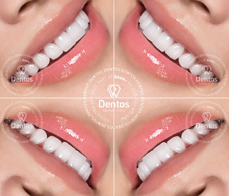 5 yếu tố vàng quyết định độ bền của răng sứ thẩm mỹ khi bọc răng sứ